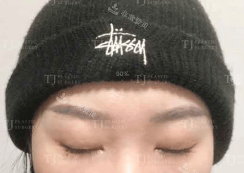韓國TJ整形切開法雙眼皮術(shù)后閉眼照片