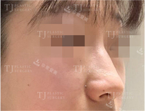 山根低鼻子照片 山根低鼻子照片