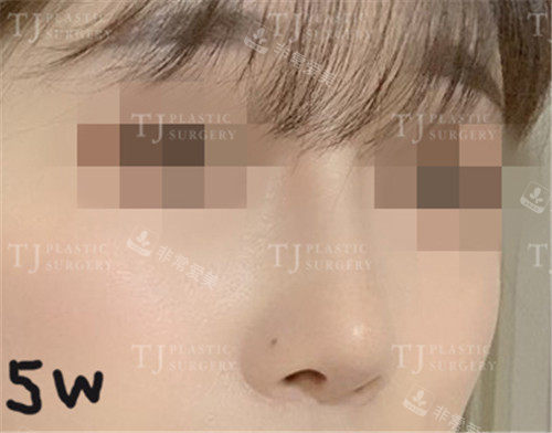 韩国TJ整形隆鼻术后5周照片