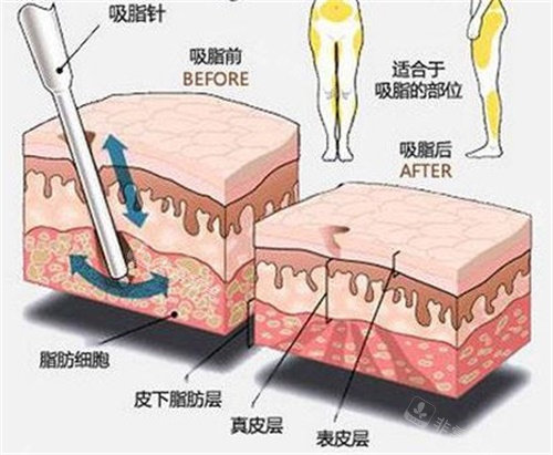 吸脂前后對比圖