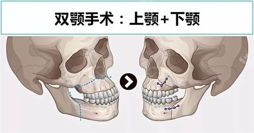 雙鄂手術(shù)示意圖