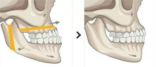 雙鄂手術(shù)圖片