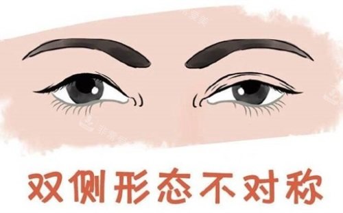 雙眼皮形態(tài)不對稱示意圖