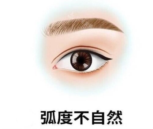 雙眼皮弧度不自然示意圖 雙眼皮弧度不自然示意圖
