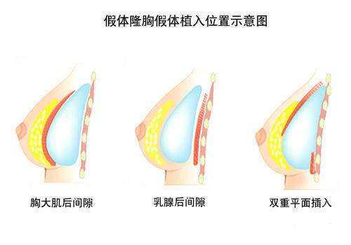 假體隆胸示意圖