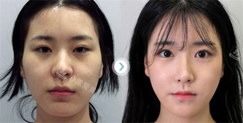 韩国faceplus整形面部轮廓真人手术图