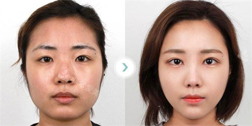 韩国faceplus整形面部轮廓手术对比图