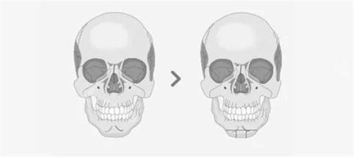 面部轮廓手术3D模拟图