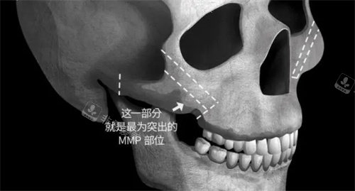 顴骨MMP點(diǎn)詳細(xì)位置參考圖 顴骨MMP點(diǎn)詳細(xì)位置參考圖