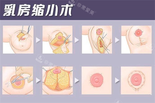 乳房缩小术示意图