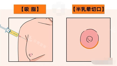 縮胸方法示意圖 縮胸方法示意圖