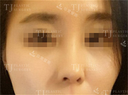 韩国TJ整形鼻翼缩小术后恢复图