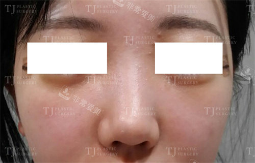 韩国TJ整形隆鼻术前图片