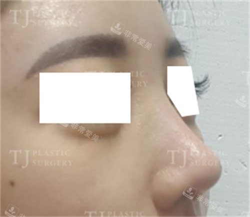 韩国TJ整形隆鼻术后侧面图