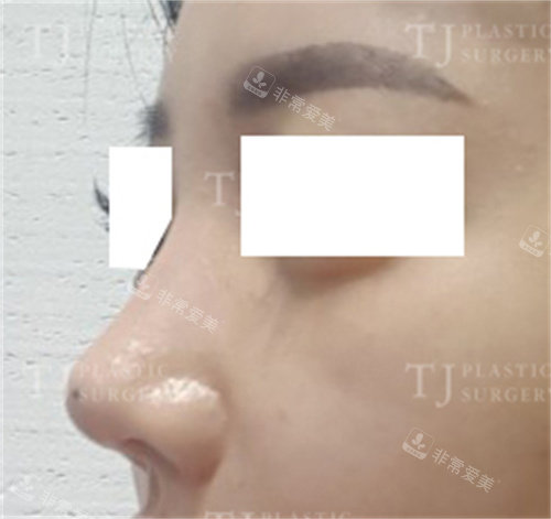 韩国TJ整形隆鼻术后侧面图