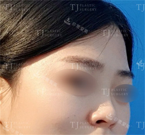 韩国TJ整形隆鼻+脂肪填充术前图片