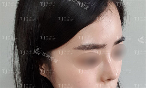 韩国TJ整形隆鼻+脂肪填充术后侧面图