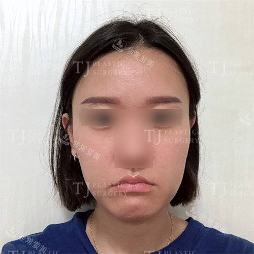 韩国TJ整形脂肪填充术前图片 韩国TJ整形脂肪填充术前图片