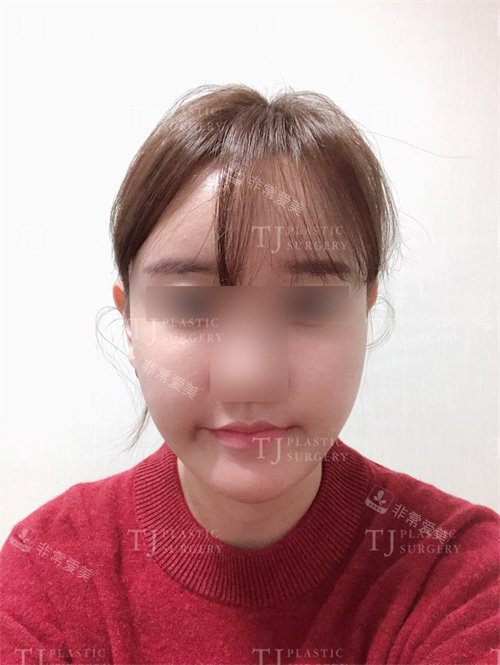 韩国TJ整形脂肪填充术后正面图 韩国TJ整形脂肪填充术后正面图