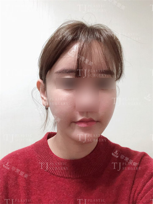 韩国TJ整形脂肪填充术后对比图 韩国TJ整形脂肪填充术后对比图