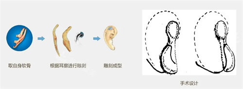 耳再造全包法流程图