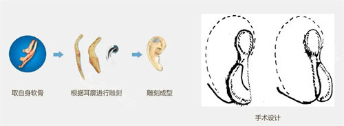 耳再造全包法流程图 耳再造全包法流程图