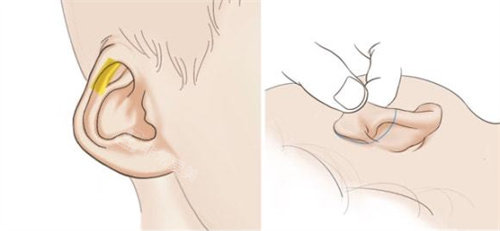 耳再造手术操作手法展示图