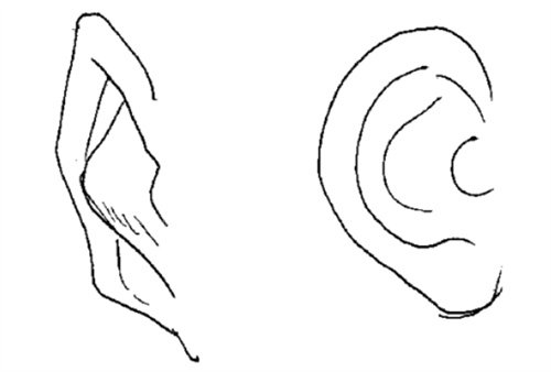 耳部畸形情况参考图