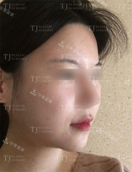 韩国TJ整形脂肪填充术前侧面图