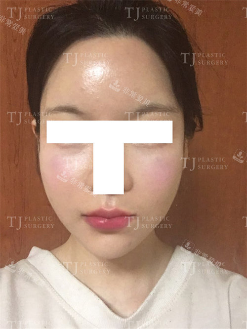 韓國(guó)TJ整形脂肪填充術(shù)后正面圖片