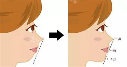 隆鼻前后面部变化对比图