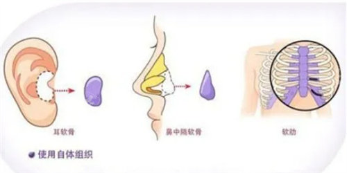耳软骨隆鼻手术流程图