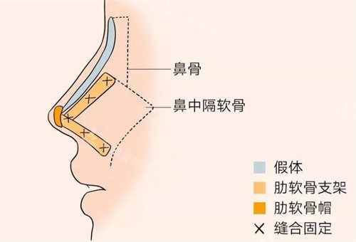 自体软骨隆鼻手术方法展示图