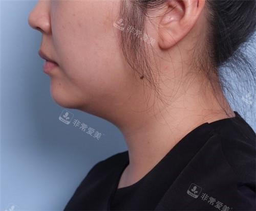 美爾韓醫(yī)院V-Chin下巴溶脂激光+輪廓針術(shù)前圖 美爾韓醫(yī)院V-Chin下巴溶脂激光+輪廓針術(shù)前圖