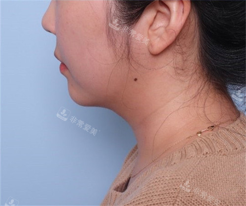 美爾韓醫(yī)院V-Chin下巴溶脂激光+輪廓針術(shù)后圖 美爾韓醫(yī)院V-Chin下巴溶脂激光+輪廓針術(shù)后圖