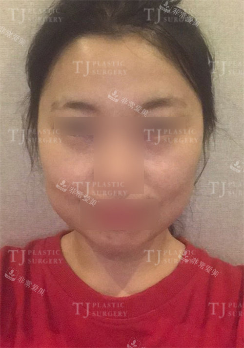 韩国TJ整形外科面部轮廓术前图