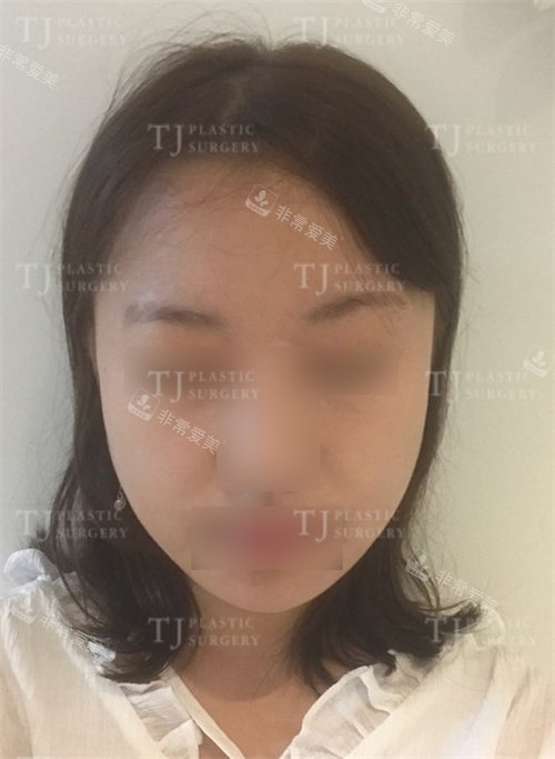 韩国TJ整形外科面部轮廓术后图