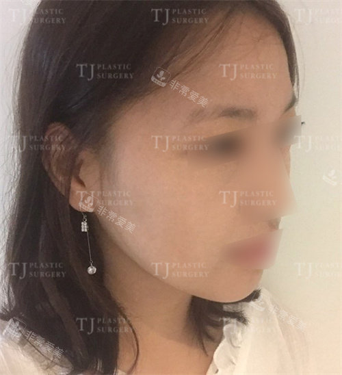 韩国TJ整形外科面部轮廓术后侧面图