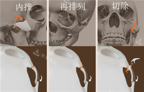 韩国现代美学整形颧骨整形动画图