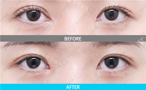 韩国歌娜整形外科眼部整形对比照