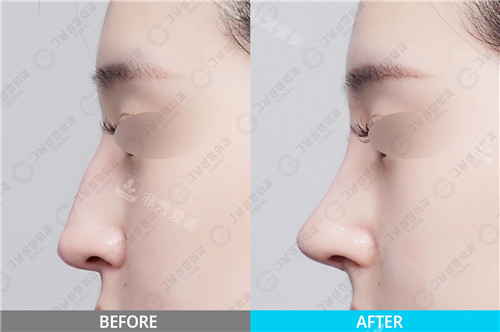 韩国歌娜整形外科鼻部整形对比照