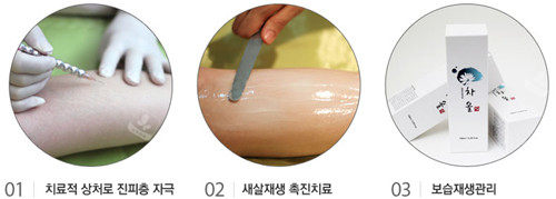 疤痕治療過(guò)程圖 疤痕治療過(guò)程圖