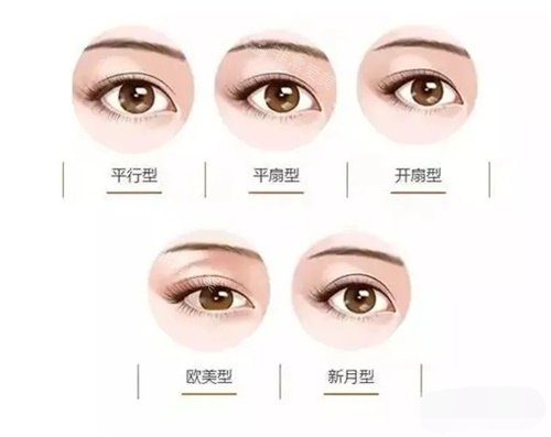 各種類型的雙眼皮示意圖