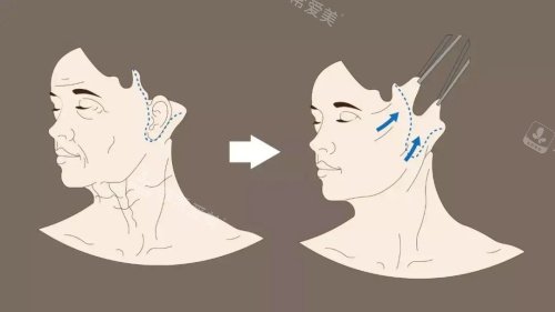 拉皮術(shù)前術(shù)后對比圖 拉皮術(shù)前術(shù)后對比圖