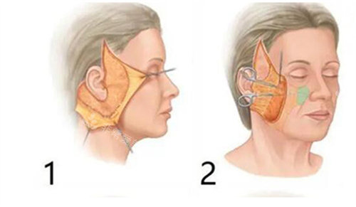 面部拉皮剥离提升操作方法图
