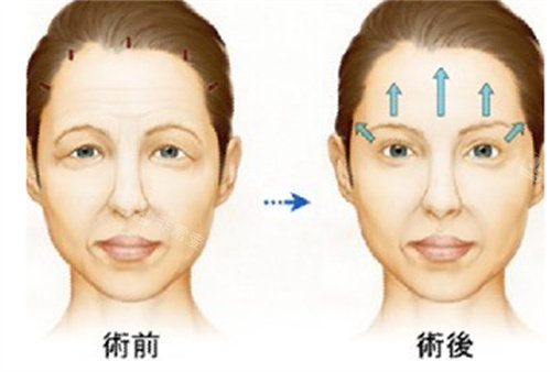 面部拉皮动画对比图 面部拉皮动画对比图