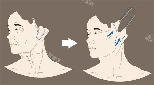 面部拉皮手术切口展示图