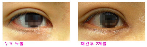 韩国EVE整形外科眼角修复对比照