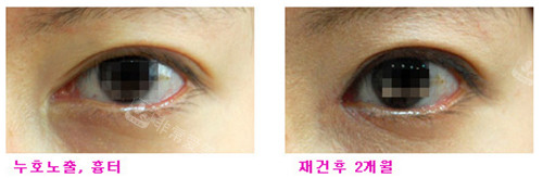 韩国EVE整形外科眼角修复前后图