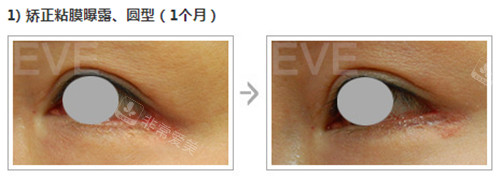 韩国EVE整形外科眼角修复对比照